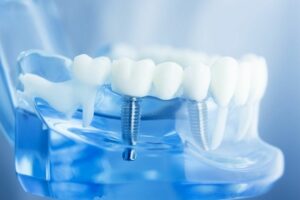 Dental Implants